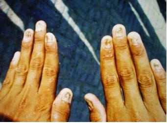 348 Antioxidant Enzyme Figure 1. Deformation of nails at people intoxicated with selenium in north-western part of India [22] 2.