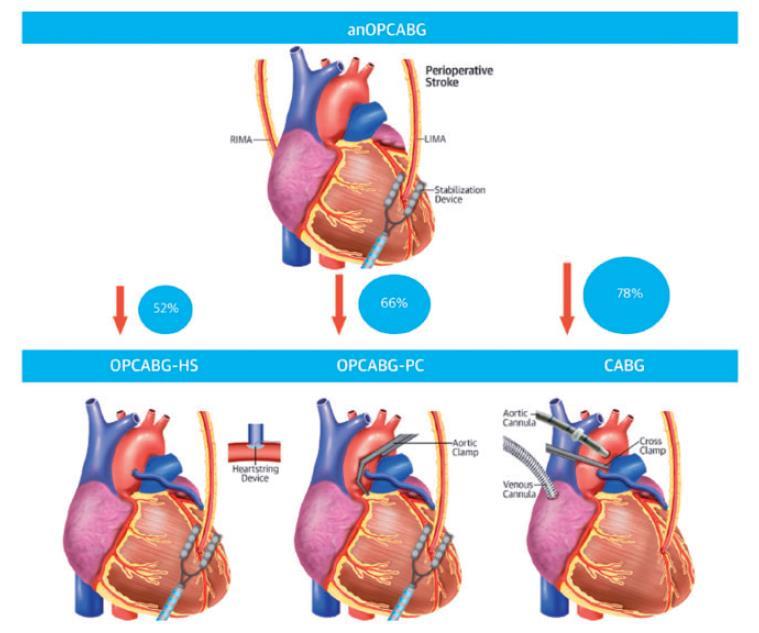 2b. Four Surgical Methods Of CABG With > Degrees of