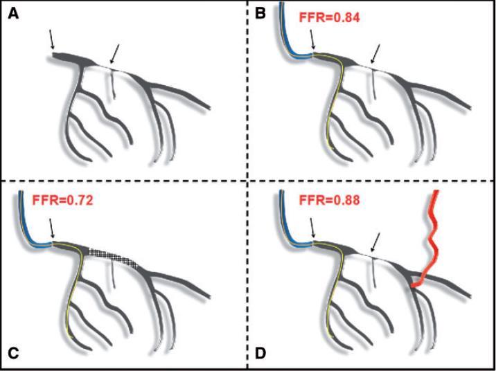 2e. FFR & Sequential Stenosis of The Ostial LM And