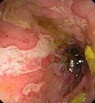 Inflammatory Bowel Diseases Dysregulation of mucosal