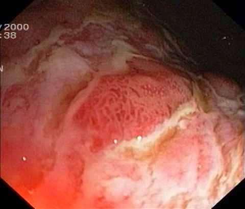 Endoscopic Results