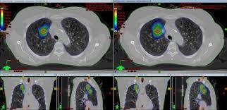 Lung Cancer: Patients live longer with Radiosurgery than with Surgery SBRT vs. Lobectomy for Operable Stage I NSCLC Source: Chang JY, Senan S, Paul MA, et al.