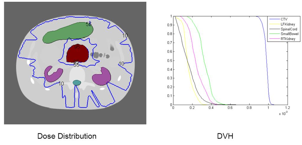 Figure 17: The dose distribution and DVH for pancreas tumor case if setup error exists with EGRT. The tumor is in red color; other colored organs are the organs at risk.