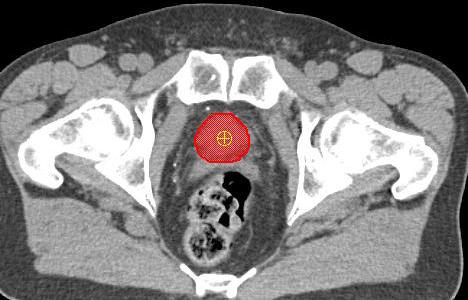 Plan Prostate Rectum Daily IGRT CT Initial