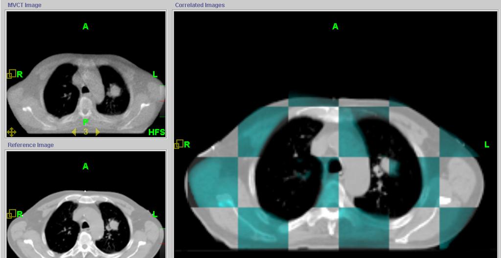 Tomotherapy Registration of Lung Case Verification CT
