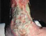 SLOUGHY WOUNDS 9 Devitalised tissue that is often moist, and yellow, white or grey in appearance. Often malodorous.