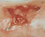 EPITHELIALISING WOUNDS 13 Wound bed is shallow with pink tissue which migrates from wound edges.