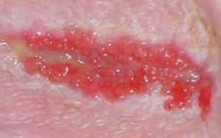 Overgranulating Wounds 15 Description: Presents clinically as granulation tissue raised above the level of the surrounding skin. The presence of overgranulation delays wound healing.