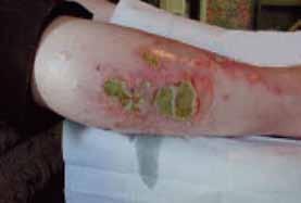 Infected Wounds 19 Description: Infection occurs when pathogenic micro-organisms deposit in the wound and evoke a reaction from the host.