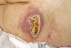Once on the ward it was assessed that he had a grade 3-pressure ulcer (EPUAP) to his right buttock.