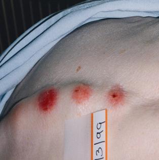 Pressure Ulcer Grading Grade 1 Grade 2 Grade 3 Grade 4 Intact skin with nonblanchable redness of a localized area usually over a bony prominence.