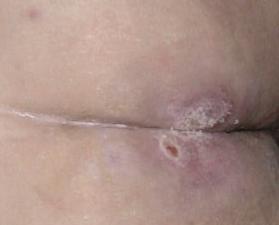 Partial thickness loss of dermis presenting as a shallow open ulcer with a red pink wound bed, without slough.