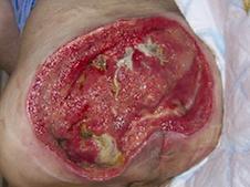 In contrast, areas of significant adiposity can develop extremely deep Category/Stage III pressure ulcers.