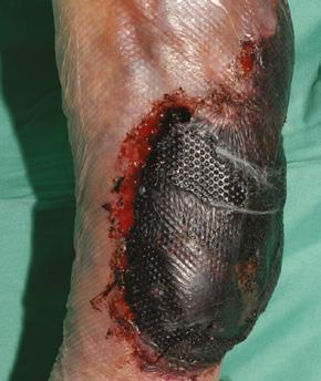 Too much or wrong wound fluid is often caused by infection, slough dead tissue and excessive eschar on the wound surface, and inflammation (Schultz G. et al. 2003).