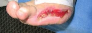 Case report diabetic foot Initial situation: