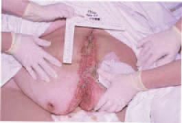 Abdominal Dehiscence Abdominal dehiscence can be described as the breakdown and separation of surgical wound edges, usually due to infection.