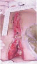 Abdominal dehiscence may also occur where there has been excessive tension placed on suture lines.