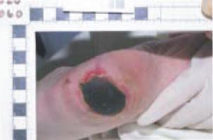 Heel Pressure Ulcers Pressure ulcers develop as a result of obstruction of blood vessels by unrelieved external pressure. Case Study 1 Heel with signi cant necrotic eschar visible.