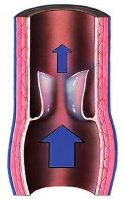 Pathogenesis of a Venous Leg Ulcer How do venous leg ulcers develop?