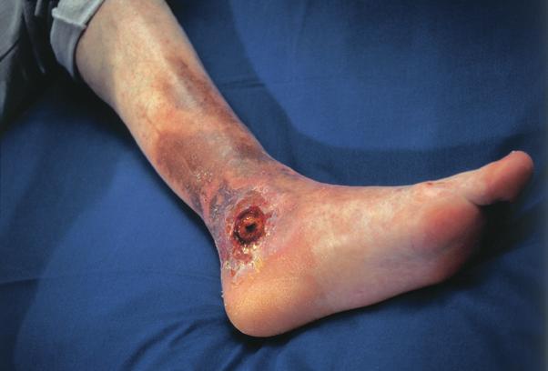 The wounds are mostly located on the inside of the lower leg: About 80% of ulcerations are located around the ankle and