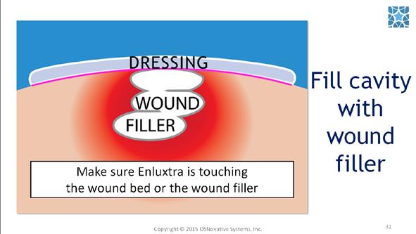 #31. For deep or tunneling wounds, pack the cavity with a wound filler and apply Enluxtra making