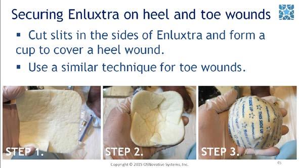 #45. Enluxtra is perfect for heel and toe wounds. Simply cut slits in the sides of the dressing and form a cup to cover a heel wound; use a similar technique for toe wounds.