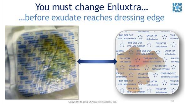 #55. Remember to always change Enluxtra before the exudate reaches the dressing edge.
