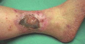 Leg Ulcers Origin