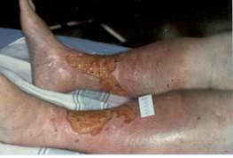 Causes of Leg ulcers Vascular disorders Lymphatic disorders