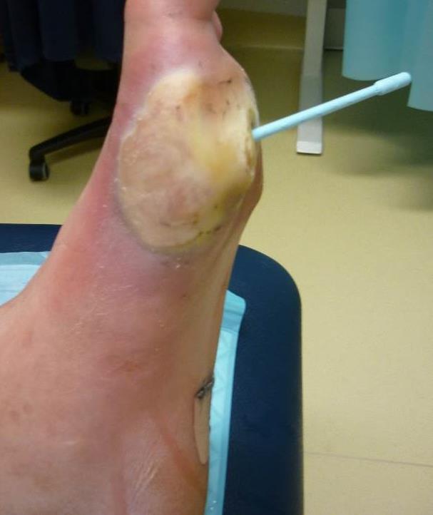 Diabetic foot examination D - deformity I - infection A - atrophic nails B -