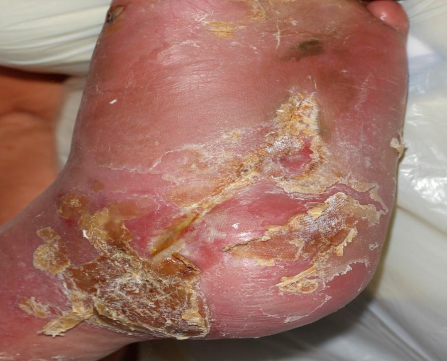 Repeated Diabetic foot abscesses 59 old
