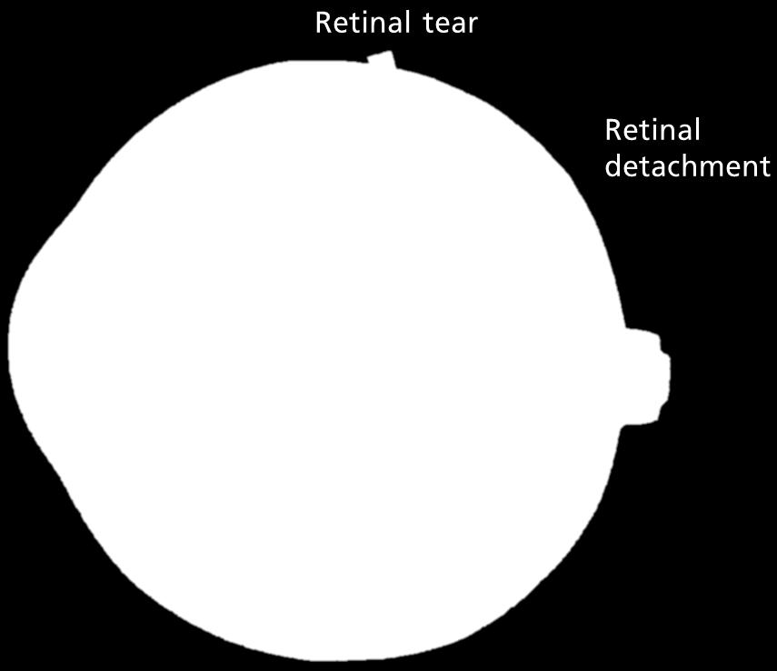 holes in the retina and reattach the retina.