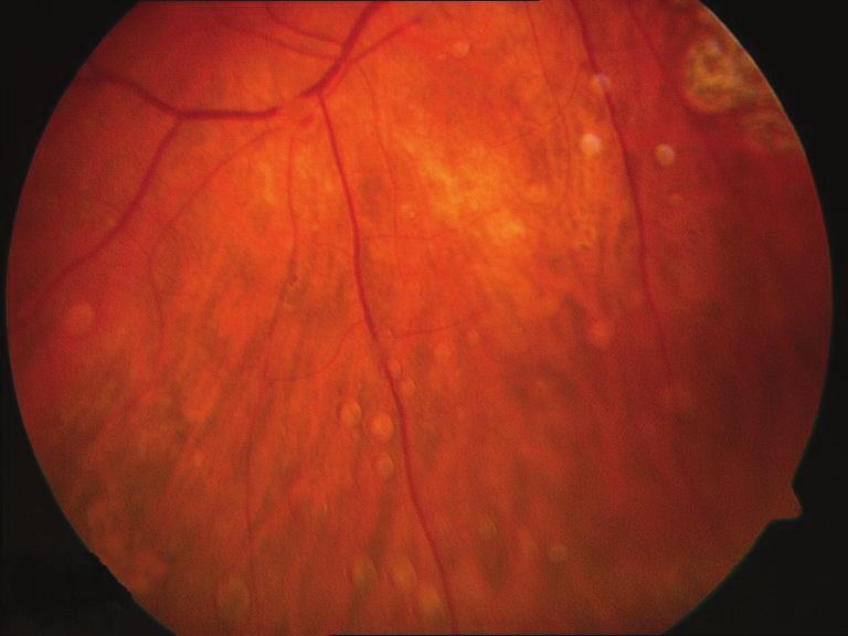 inflammation of the individual patient s eye, which explains the relative wide standard deviation (SD) of the mean residencetimeofthehso.