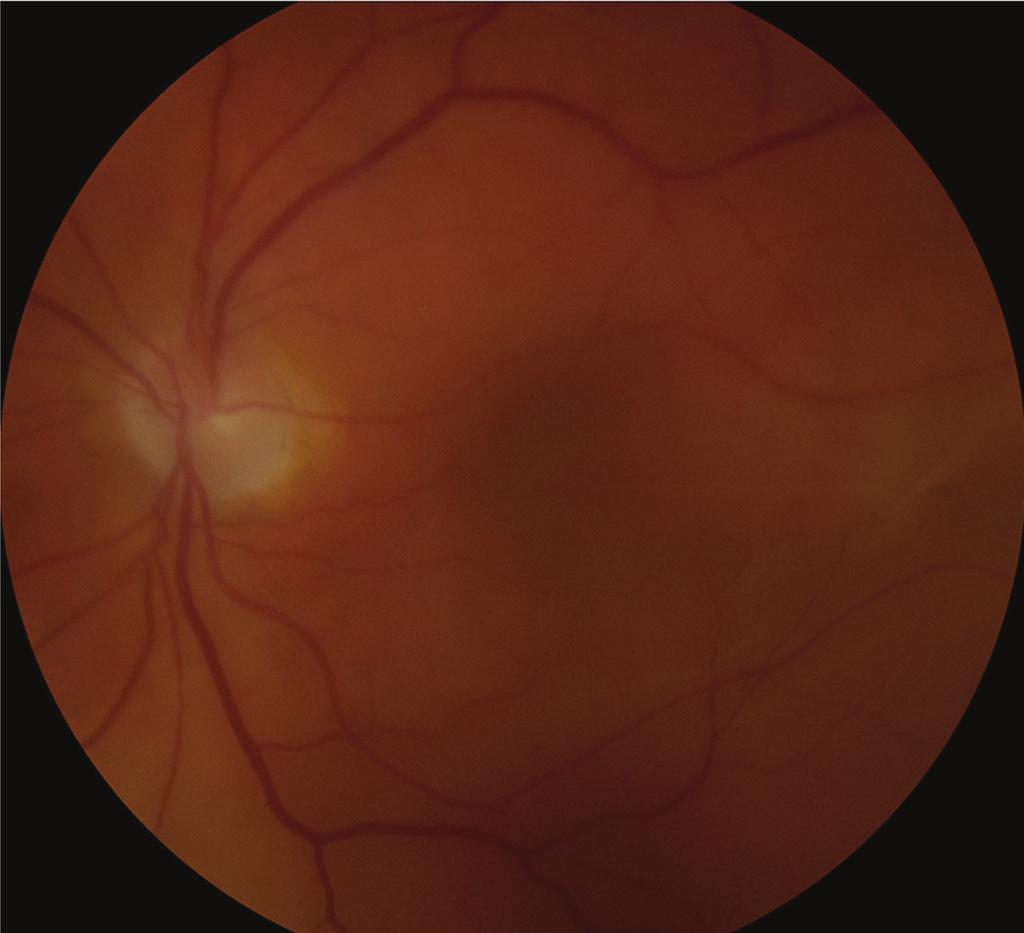 2 vitreous haemorrhage as biomicroscopy assessment showed the detachment stopping inferior to the macula (Figure 1).