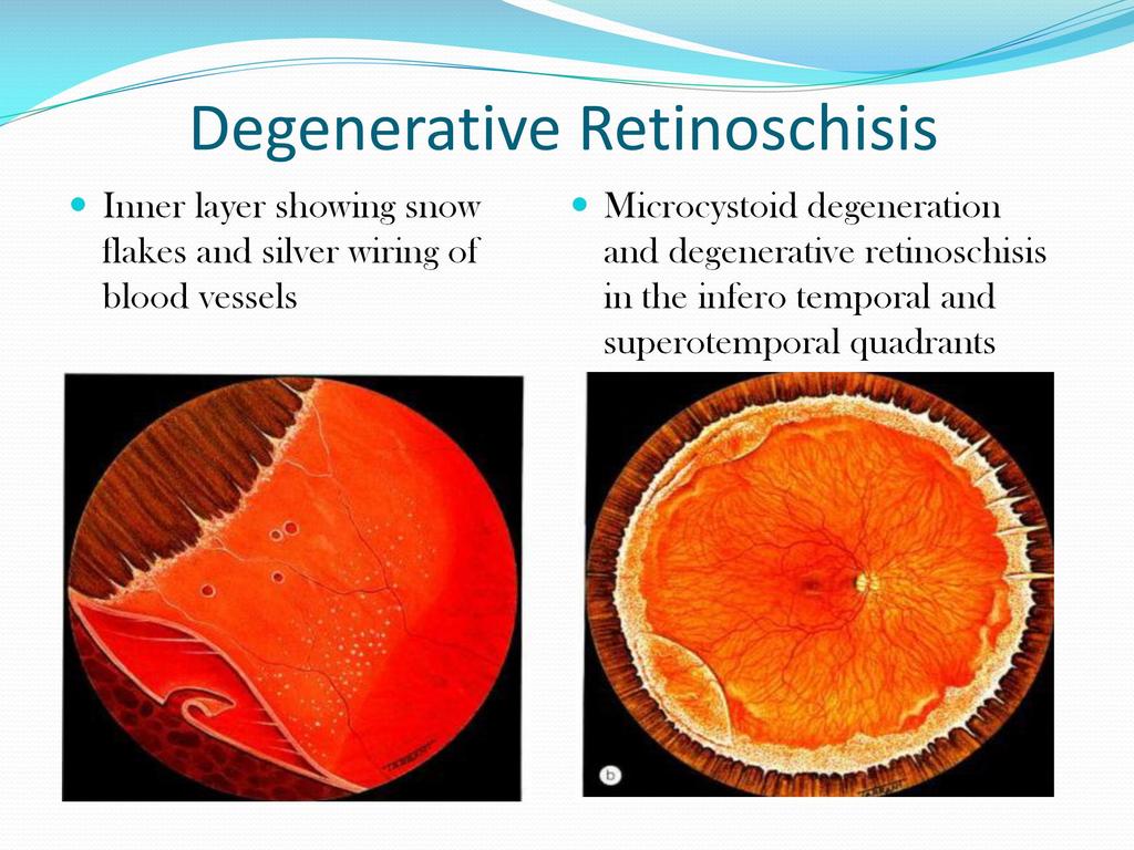 Degenerative Retinoschisis Inner