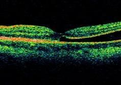 Optical coherence tomography (OCT) Reveal subfoveal