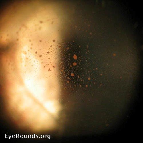 Decement s membrane folds Iritis : Cells and flare may be seen in the anterior chamber Pigment