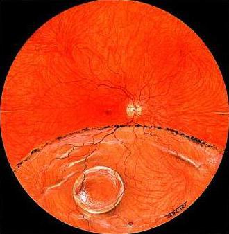 LONG-STANDING RETINAL DETACHMENT Main features of long-standing Rhegmatogenous retinal
