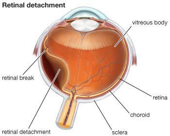 Introduction Definition : Retinal deatchment is the separation of the neurosensory retina(nsr) from the retinal