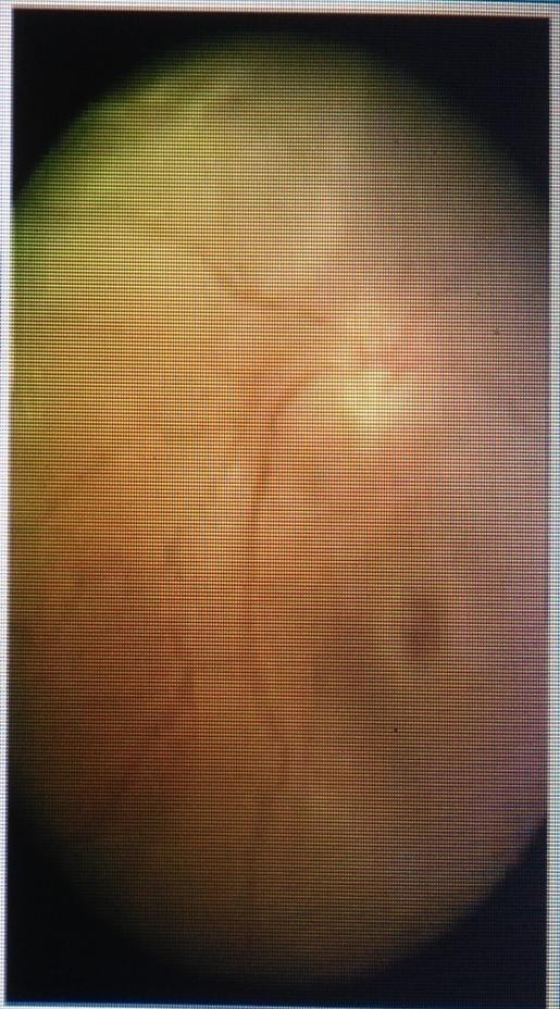 EXAMINATION OF MACULA Done with 90D or