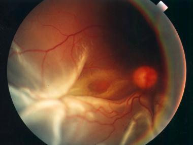 COMPLEX RETINAL DETACHMENT Gaint retinal tear Posterior break macular hole Large tears,multiple tears Media
