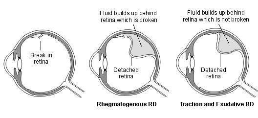 TYPES 1. Rhegmatogenous Retinal detachment : Full thickness defect in the sensory retina (break) 2.