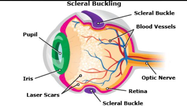 SCLERAL BUCKLING Indications Rhegmatogenous retinal detachment Detachments due to dialysis