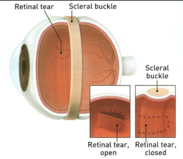Sclera pushed inward Scleral buckling Reapposes Retinal pigment epithelium to