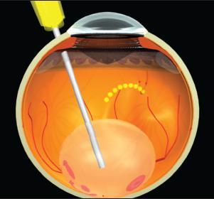 4.Sub-retinal fluid drainage Not indicated in all cases Indications übullous Retinal detachment ülong