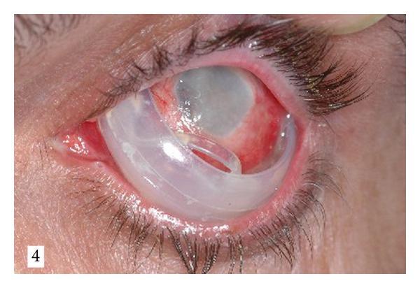 Complications of scleral buckling Postoperative glaucoma Anterior segment