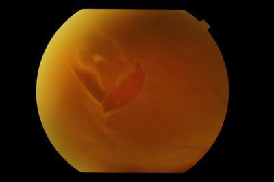 Retinal breaks Any full thickness