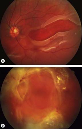 Indications: Non resolving vitreous opacities Proliferative vitreo-retinopathy Giant retinal tears