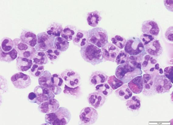 ANCILLARY STUDIES Flow Cytometry - Leukemia/Lymphoma Profile: Increased CD56 positive granulocytes.