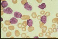 Disease Usual phenotype acute leukemia precursor